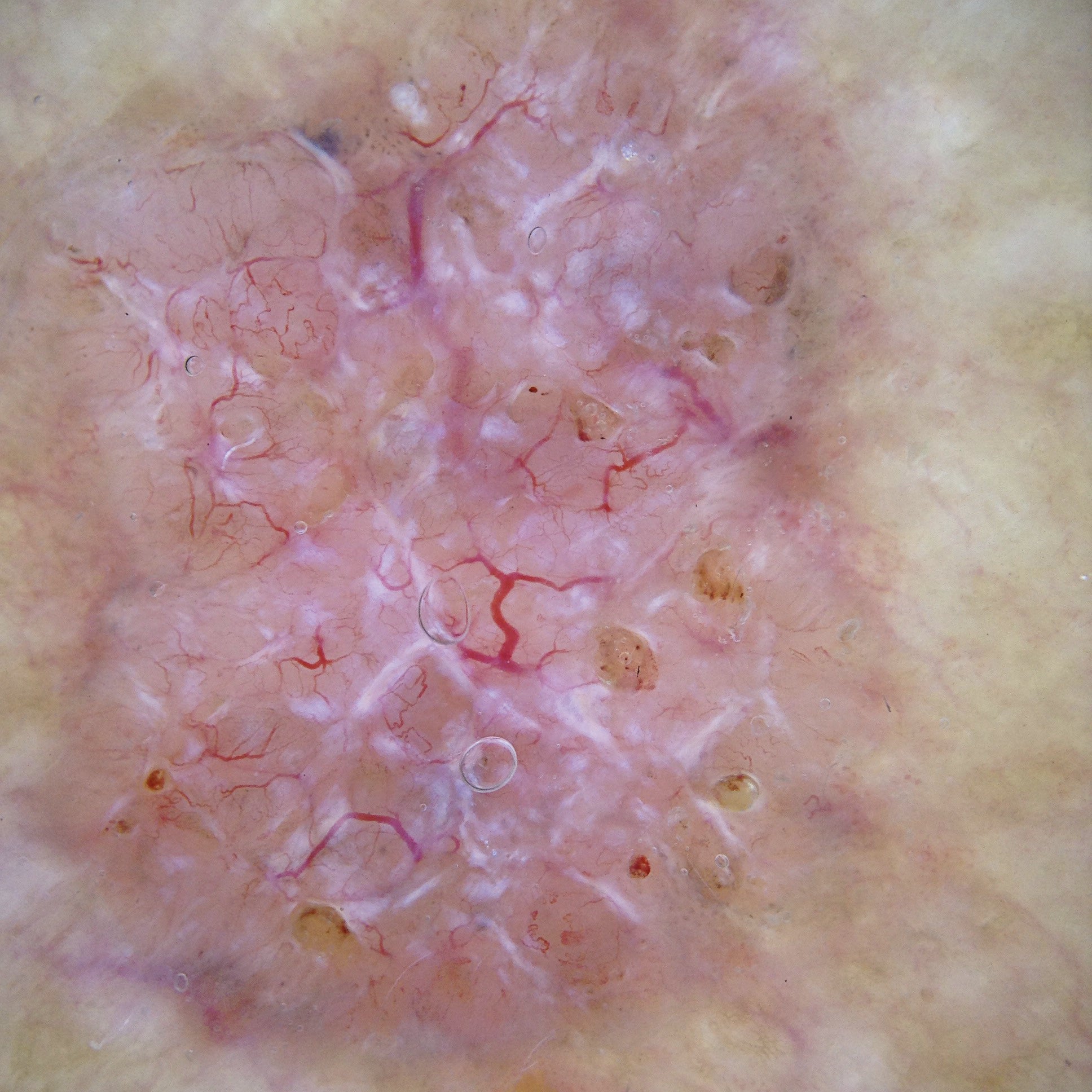 
Skin image under cross-polarized light